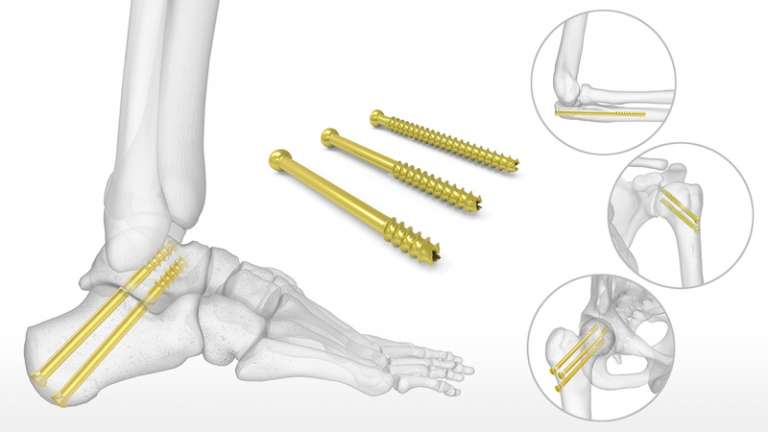 Fixation of The Cancellous Bone in Orthopedic Surgery
