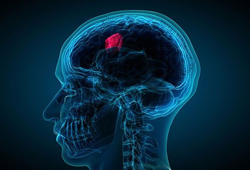 A Complete Guide To Brain Tumour Treatment