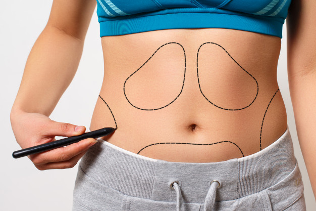 Tummy tuck best way to remove fat