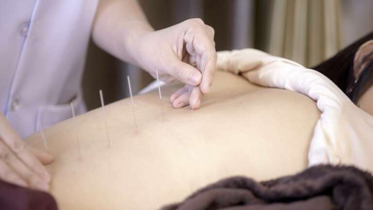 A Complete Guide About Acupuncture Benefits and Side Effects