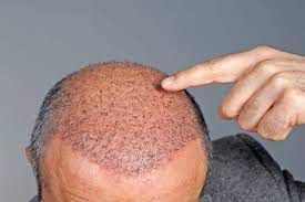 Why Don’t They Call It a “Hair Transplant”? Reasons to Downplay This Surgery.