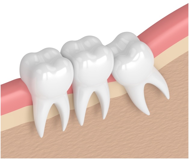 How Is the Wisdom Tooth Extraction Process?