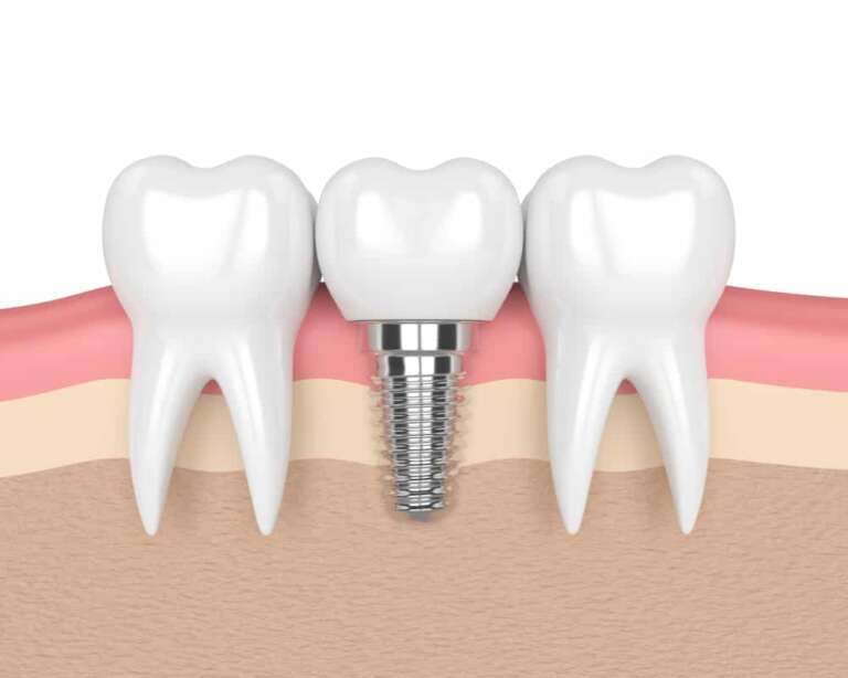 Dental Implants Services: A Gateway to Confident Smiles