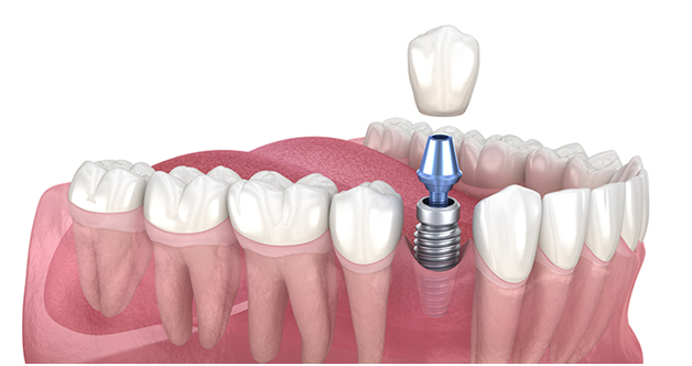 Is It Possible to Have Multiple Dental Implants?